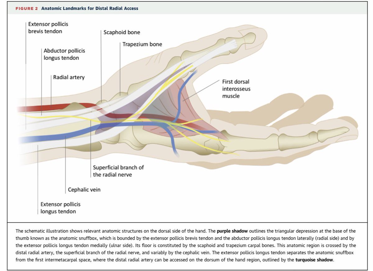 SRLCardiologia's tweet photo. Great video showing the Distal transradial approach in anatomical snuffbox step by step https://t.co/kACiOTLKd8 via @YouTube #interventionalcardiology #RadialFirst #cardiology https://t.co/lcgVpWiCAx