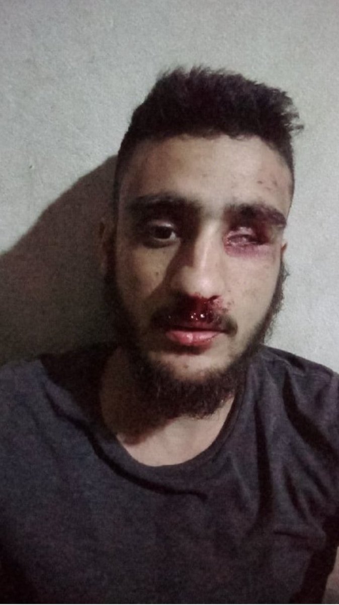 QamisloNews's tweet photo. فقء العين، آخر طرق التعذيب التي يوصل ارتكابهامسلحون موالون لتركيافي عفرين:
في جريمة بشعةأخرى شهدتهامدينة #عفرين الخاضعةلسيطرةالمسلحين الموالين لتركيافي شمال سوريا، أقدم عناصر من الفرقة الخاصة التابعة لفيلق الشام بقيادة“عبدالله حلاوة”على ضرب أحد المدنيين وفقء عينه في بلدةالباسوطة. https://t.co/tCEbHVhUYh