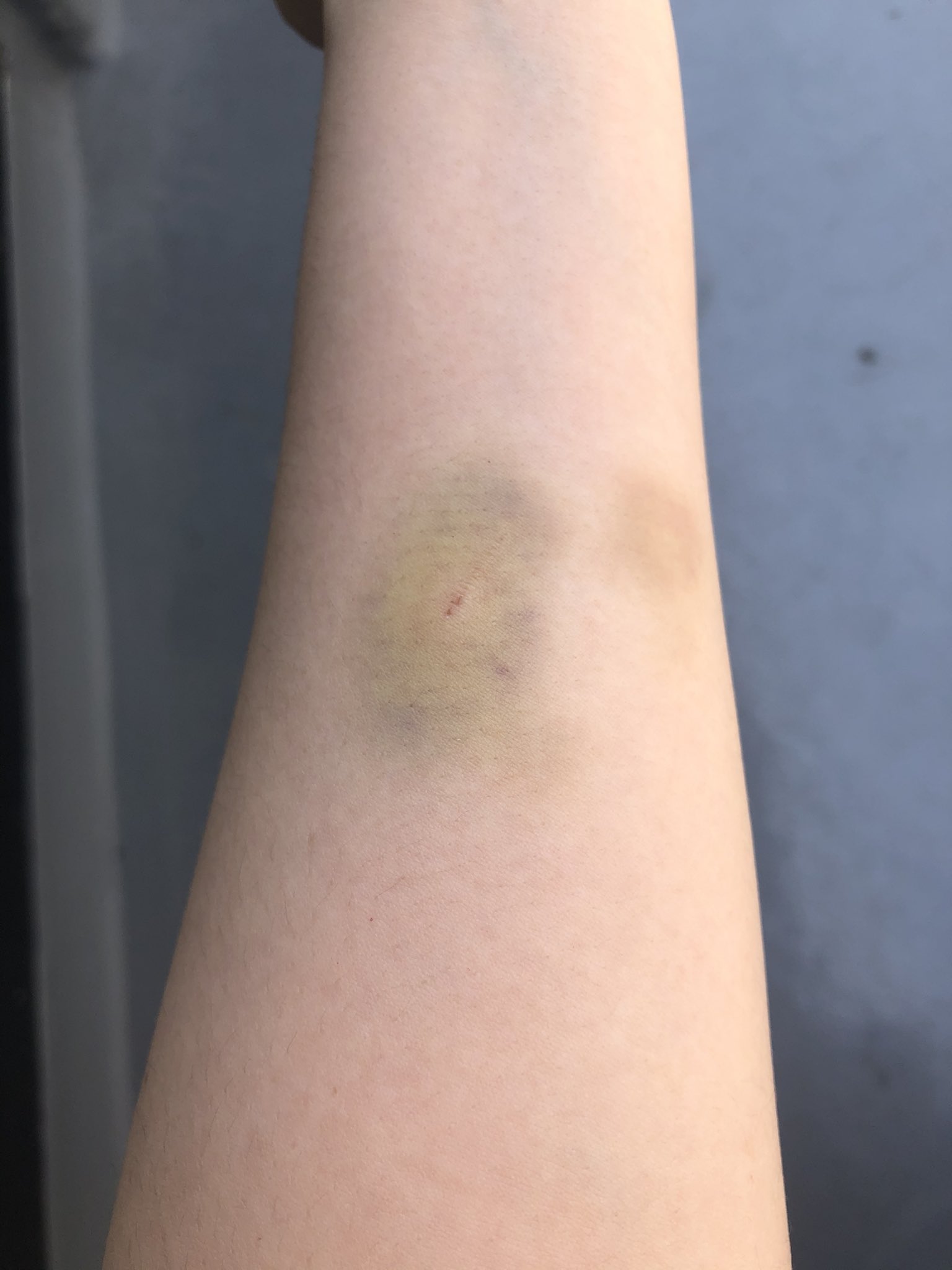 さとう みずき 1週間前に犬たちがガチギレの喧嘩してて仲裁に入ったら噛まれたとこエグい青痣になってて笑う 2枚目は噛んだ張本人 T Co Evwnsl53tx Twitter