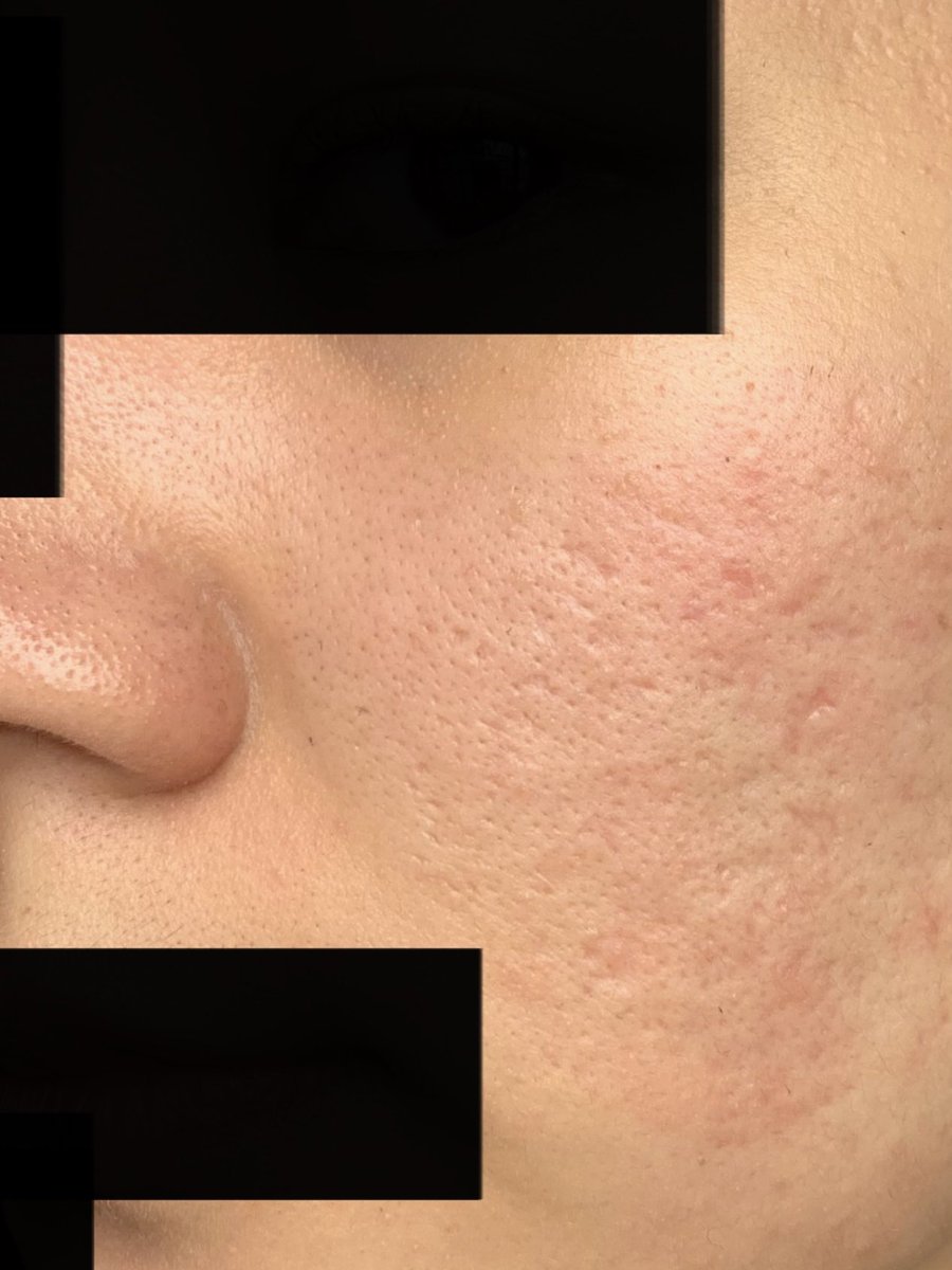 うふふ V Twitter この深そうな毛穴は本当に毛穴なのか アイスピック型クレーターな気がしなくもない