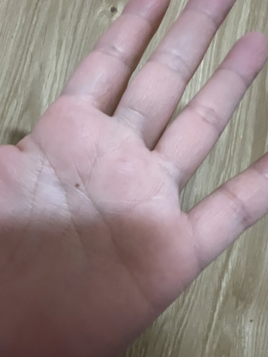 手のひらのホクロ 手のひらのホクロ