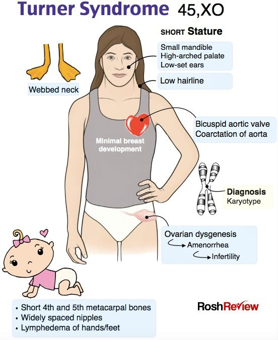 turner syndrome facts