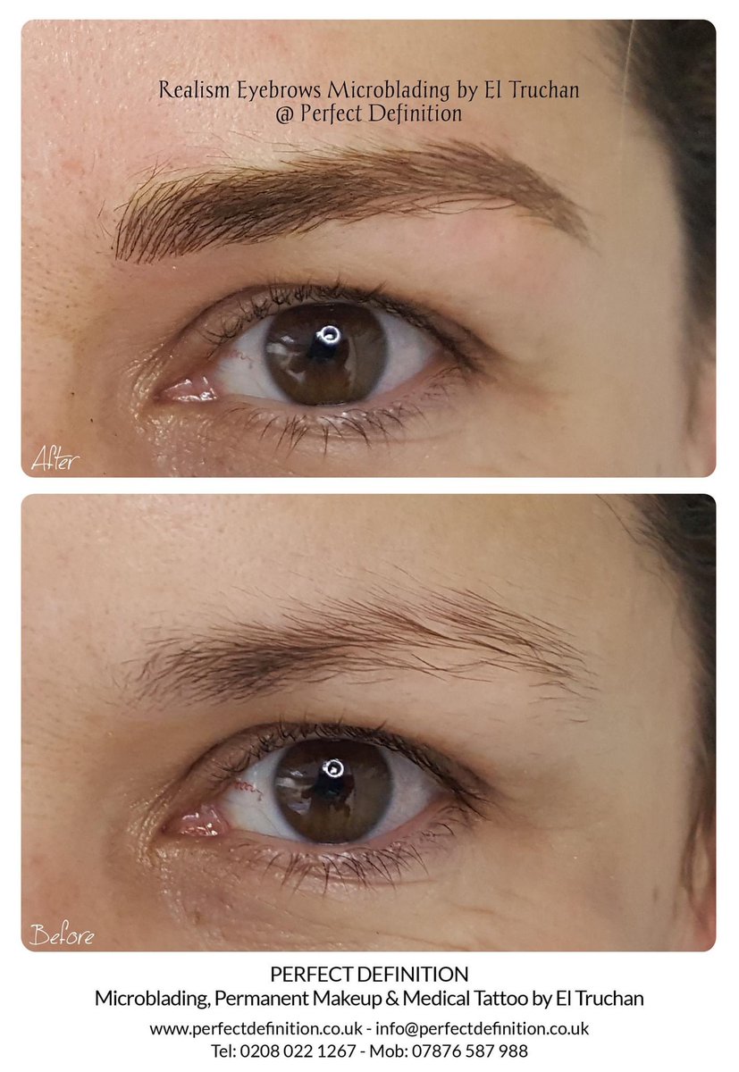 ElTruchan's tweet image. Realism Eyebrows Microblading by El Truchan @ Perfect Definition
#permanenteyebrowsshape #permanenteyebrowtattoo #digitalmicroblading #hairstrokes #browqueen #browformation #nanoblading #nano-blading