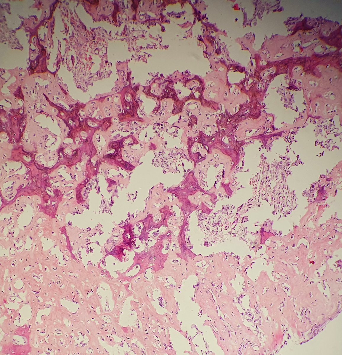 monadahal's tweet photo. 18y/male, c/o swellimg and pain over right thumb, near proximal nail fold for 1 yr
Squestrum identified while taking biopsy
Xray- cortical erosion in distal phalanx of right thumb with adjacent mild soft tissue swelling 
D/D Xray 1. Glomus tumor 2.  Infective #BSTpath #dermapath https://t.co/Y83Ztv2ncG