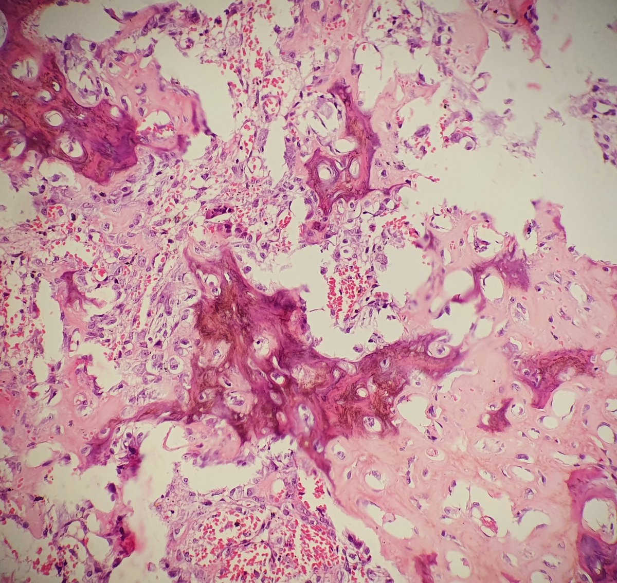 monadahal's tweet photo. 18y/male, c/o swellimg and pain over right thumb, near proximal nail fold for 1 yr
Squestrum identified while taking biopsy
Xray- cortical erosion in distal phalanx of right thumb with adjacent mild soft tissue swelling 
D/D Xray 1. Glomus tumor 2.  Infective #BSTpath #dermapath https://t.co/Y83Ztv2ncG