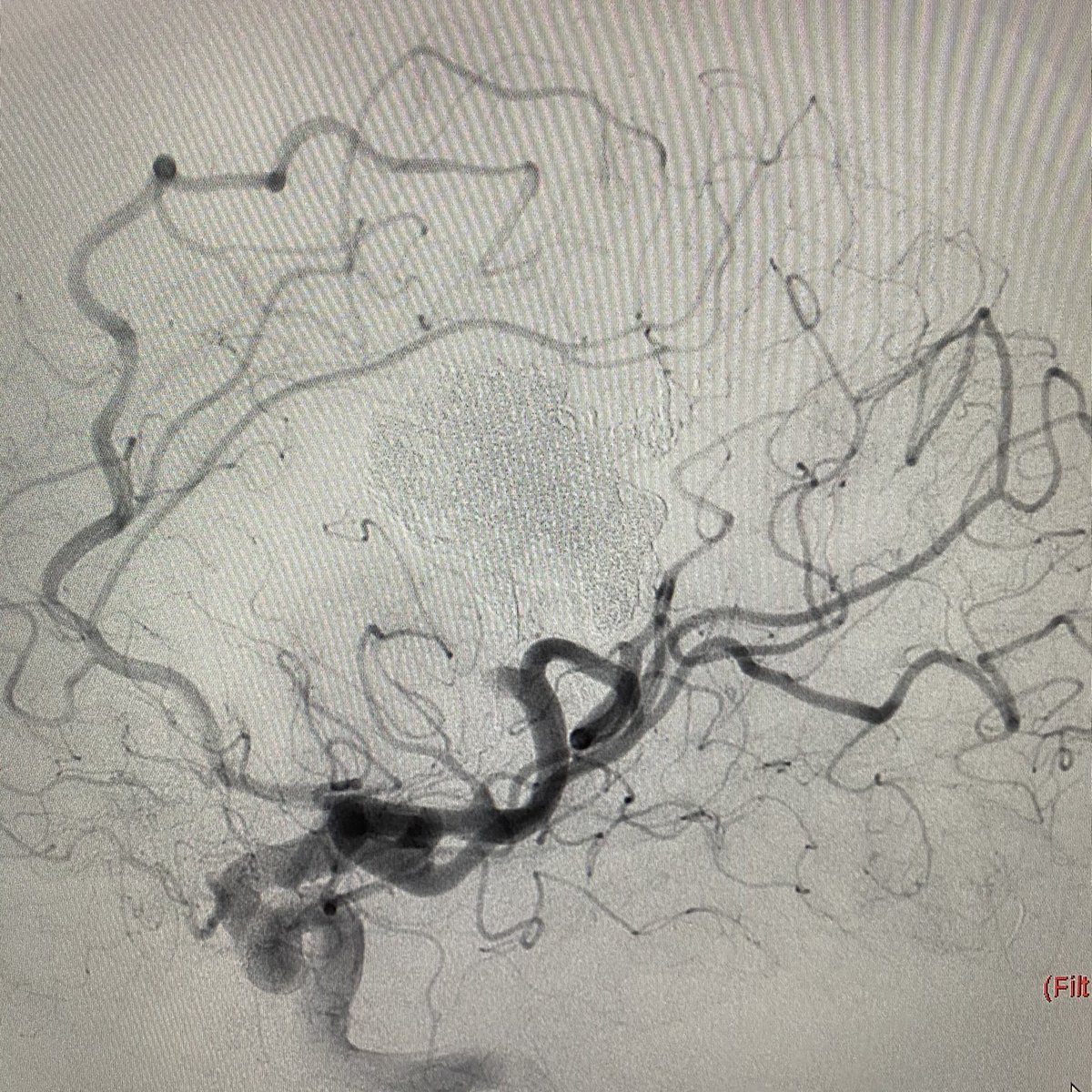 Daniel Abud (@neuroabud) on Twitter photo Double arterial Catheter and venous pressure cooker to cure an brain AVM by endovascular approach. Is it beautiful or what? <a href="/LINNConline/">LINNC online đ§ </a> <a href="/SNISinfo/">SNIS Info</a> <a href="/DoctorGaldamez/">Mario MartĂnez-GaldĂĄmez</a> <a href="/JNeuroradiology/">Journal of Neuroradiology</a> <a href="/eneri_neuro/">ENERI - Dr. Pedro Lylyk</a> Double arterial Catheter and venous pressure cooker to cure an brain AVM by endovascular approach. Is it beautiful or what? <a href="/LINNConline/">LINNC online đ§ </a> <a href="/SNISinfo/">SNIS Info</a> <a href="/DoctorGaldamez/">Mario MartĂnez-GaldĂĄmez</a> <a href="/JNeuroradiology/">Journal of Neuroradiology</a> <a href="/eneri_neuro/">ENERI - Dr. Pedro Lylyk</a>