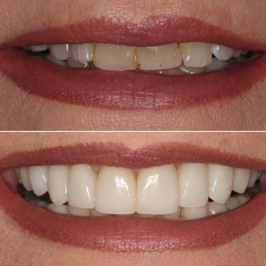 AmarilloSmiles's tweet photo. Check out this fabulous new smile! #porcelainveneers  #amarillocosmeticdentist #smilemakeover #cosmeticsmiledesign  #drmiller https://t.co/dSeOX52E3l