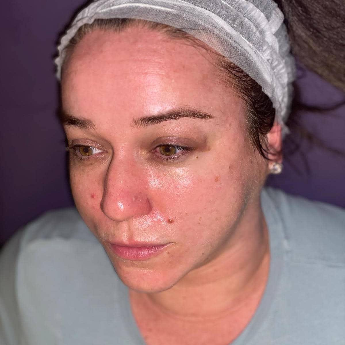 Skin peel facial by angie 
#facial #skinpeel 
We have 
facebook:-cushdy Cosmetics 
Instagram:- cushdycosmetics