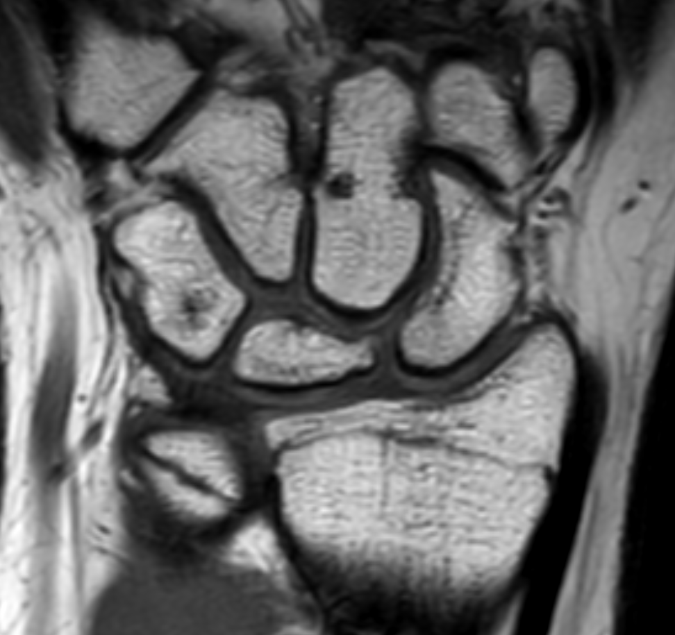 PCYintheCLE's tweet photo. Radiology cool case of the day. Spontaneous resolution of Kienbock's disease (lunatomalacia) over 6 years. The lunate collapse, fragmentation, sclerosis and marrow edema all gone at 6 year follow up with no surgical intervention. 
#mskrads #orthotwitter #radres #FOAMrad #pedrad https://t.co/qaXPfj0MUo