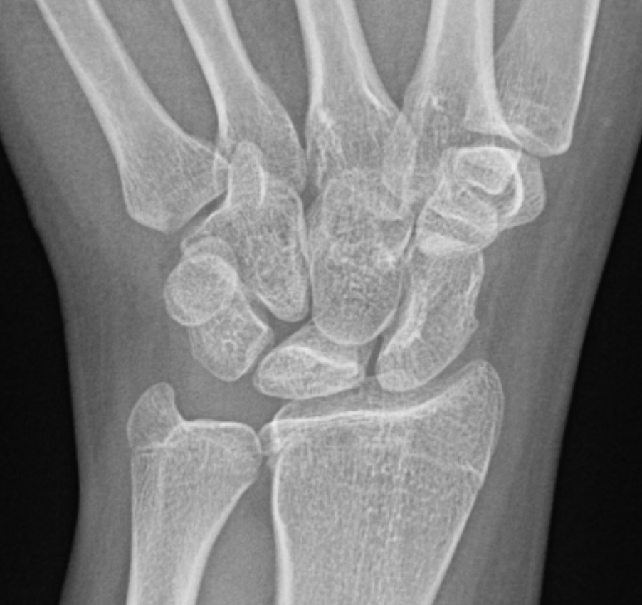 PCYintheCLE's tweet photo. Radiology cool case of the day. Spontaneous resolution of Kienbock's disease (lunatomalacia) over 6 years. The lunate collapse, fragmentation, sclerosis and marrow edema all gone at 6 year follow up with no surgical intervention. 
#mskrads #orthotwitter #radres #FOAMrad #pedrad https://t.co/qaXPfj0MUo