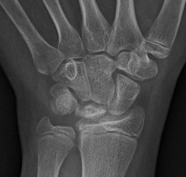 PCYintheCLE's tweet photo. Radiology cool case of the day. Spontaneous resolution of Kienbock's disease (lunatomalacia) over 6 years. The lunate collapse, fragmentation, sclerosis and marrow edema all gone at 6 year follow up with no surgical intervention. 
#mskrads #orthotwitter #radres #FOAMrad #pedrad https://t.co/qaXPfj0MUo