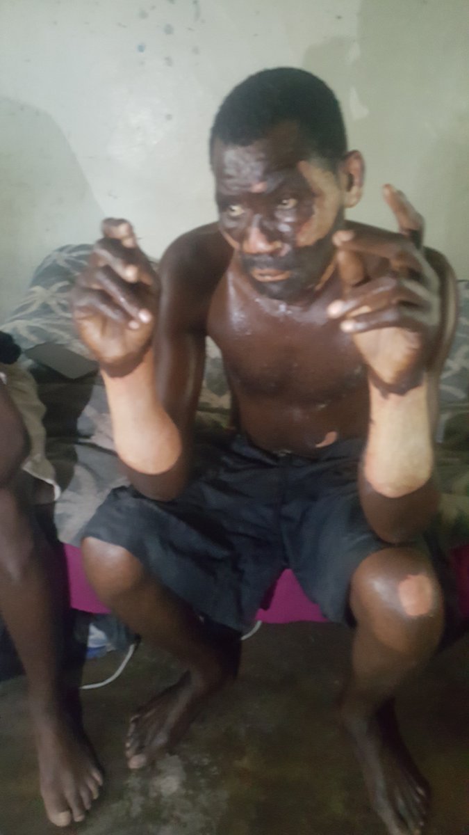 FMaguwu's tweet image. Received from Hwange: 'This guy was burnt by gas at a Chinese mine, South Mines, two days ago and was discharged after a day bcz the comp claimed they cant pay hosp bills. Jst been to see him and spoke to him. Chinese are evil'