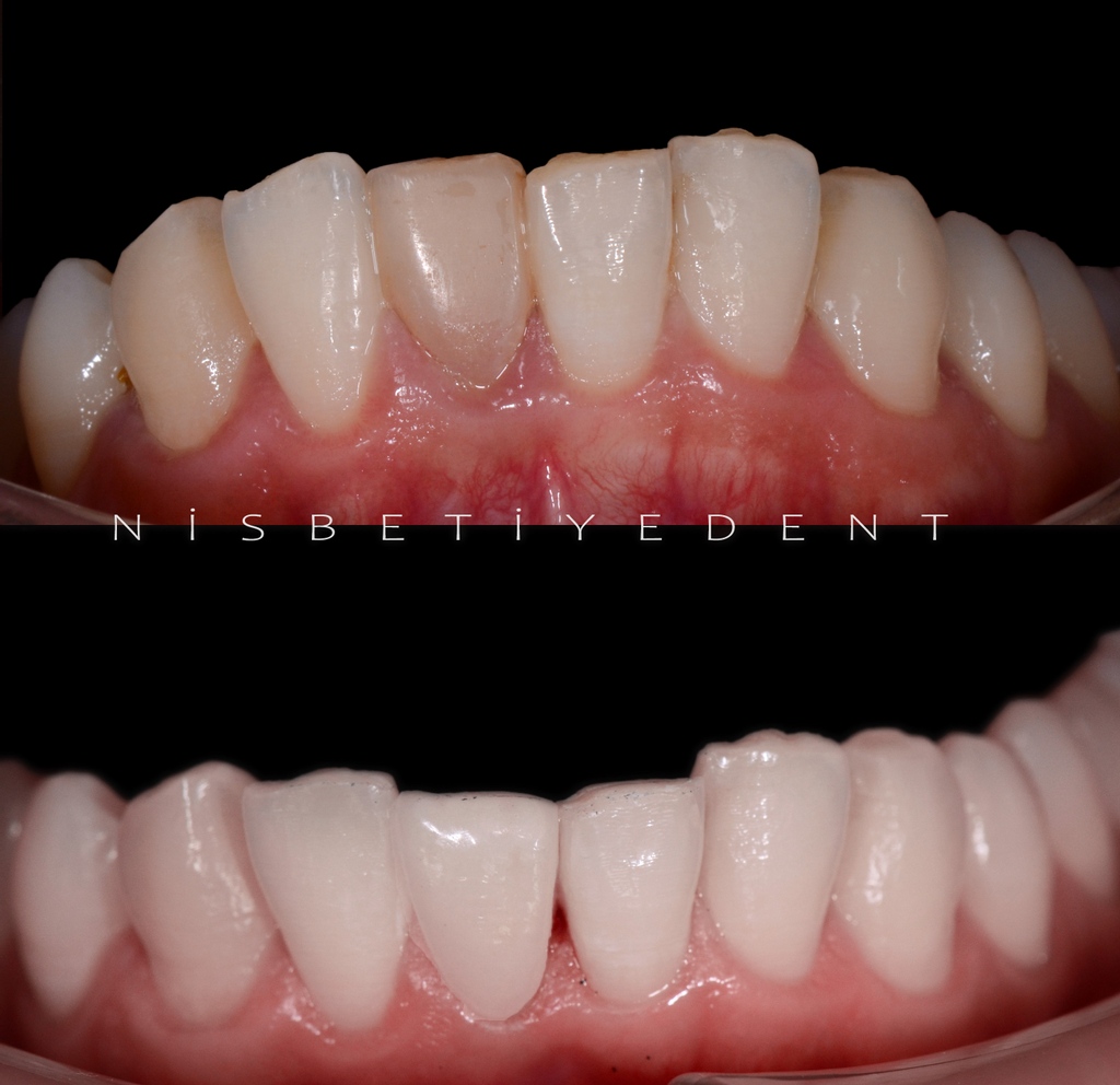 Mükemmellik ayrıntıda gizlidir👍
.
#dentist #dentistry #teeth #smile #teethwhitening #disbakimi #implant #disestetigi #saglik #dis #nisbetiyedent
#smilemakeover #cosmeticdentistry #dentista #dentists #porcelainveneers #dentistrymyworld #smilemaker
