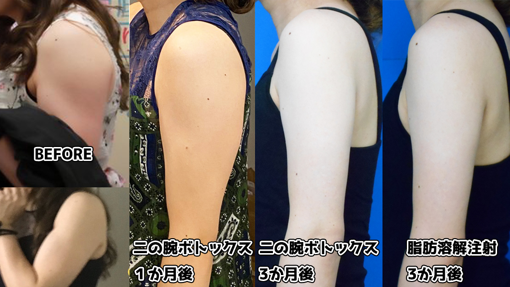 تويتر なお Onaco على تويتر 二の腕を細くする選手権 Before 二の腕ボトックス１か月 二の腕ボトックス3か月 脂肪溶解注射3か月 二の腕ボトックスは１回だけで後戻り少なく効果あり 肩幅が小さく見えるのも 脂肪溶解注射は成分と病院を選んで初めて効果を