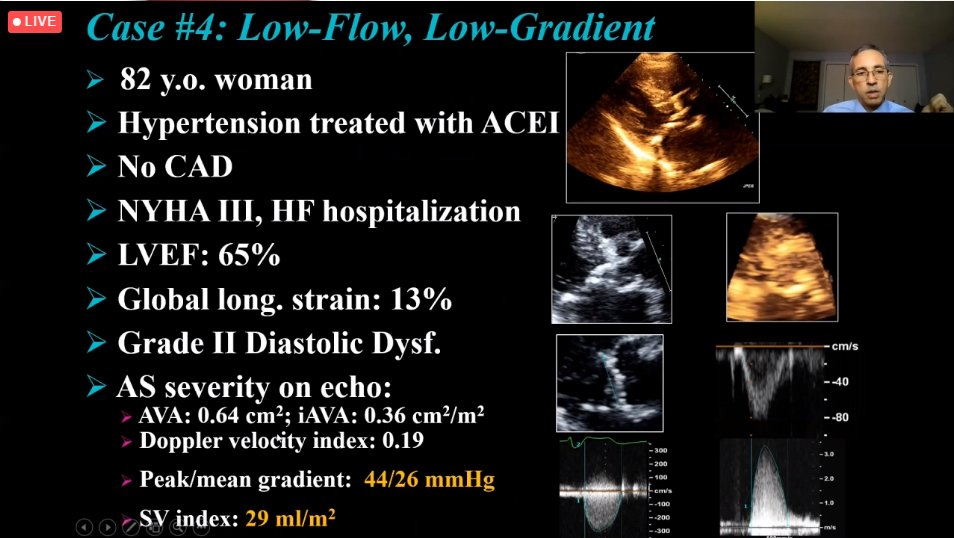 Acaba de sair de estúdio em sessão live do CPC o Dr. Philippe Pibarot, com uma apresentação com o tema “Lowflow – Lowgradient Aortic Valve Stenosis: State of the art”.
bit.ly/3vFTjXh