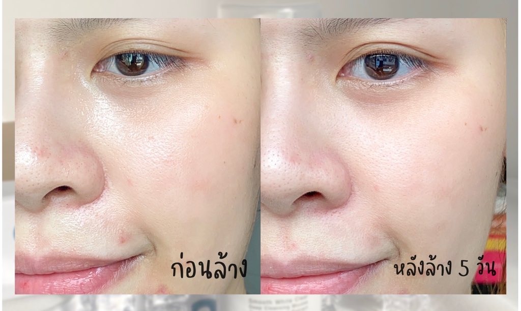 Nananblogblog's tweet photo. ไม่ต้องพึ่งเครื่องตีฟองโฟมเลยค่ะตั้งเเต่มีโฟมมูสสูตรต้านสิวตัวนี้ BLING BLINK ล้างแล้วหน้าไม่เอี๊ยดแถมยังช่วยรักษาสิวผด สิวผื่น ผลัดเซลล์ผิวและบำรุงผิวให้แข็งแรงขึ้นด้วย ไม่มีสารอันตรายที่ทำให้แพ้เลย ซื้อ 1 ได้ถึง 3 คุ้มมากอยากให้ทุกคนได้ลอง #ไว้รีวิวห้ามขายของโว้ยย #ใช้ดีบอกต่อ https://t.co/MGXIJyjqFo