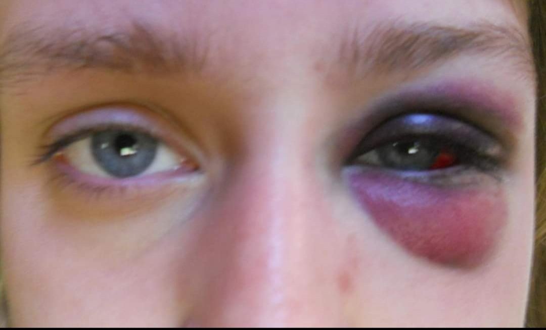 _DaniCox's tweet photo. Just wondering how Bryce Harper can take a 97 mph pitch to the face and walk away basically unscathed but when I got hit in the face while playing pitch &amp; catch with my big brother in high school, I came out looking like this. (Side note, super glad he's okay!) https://t.co/8wa3ZxR8WT