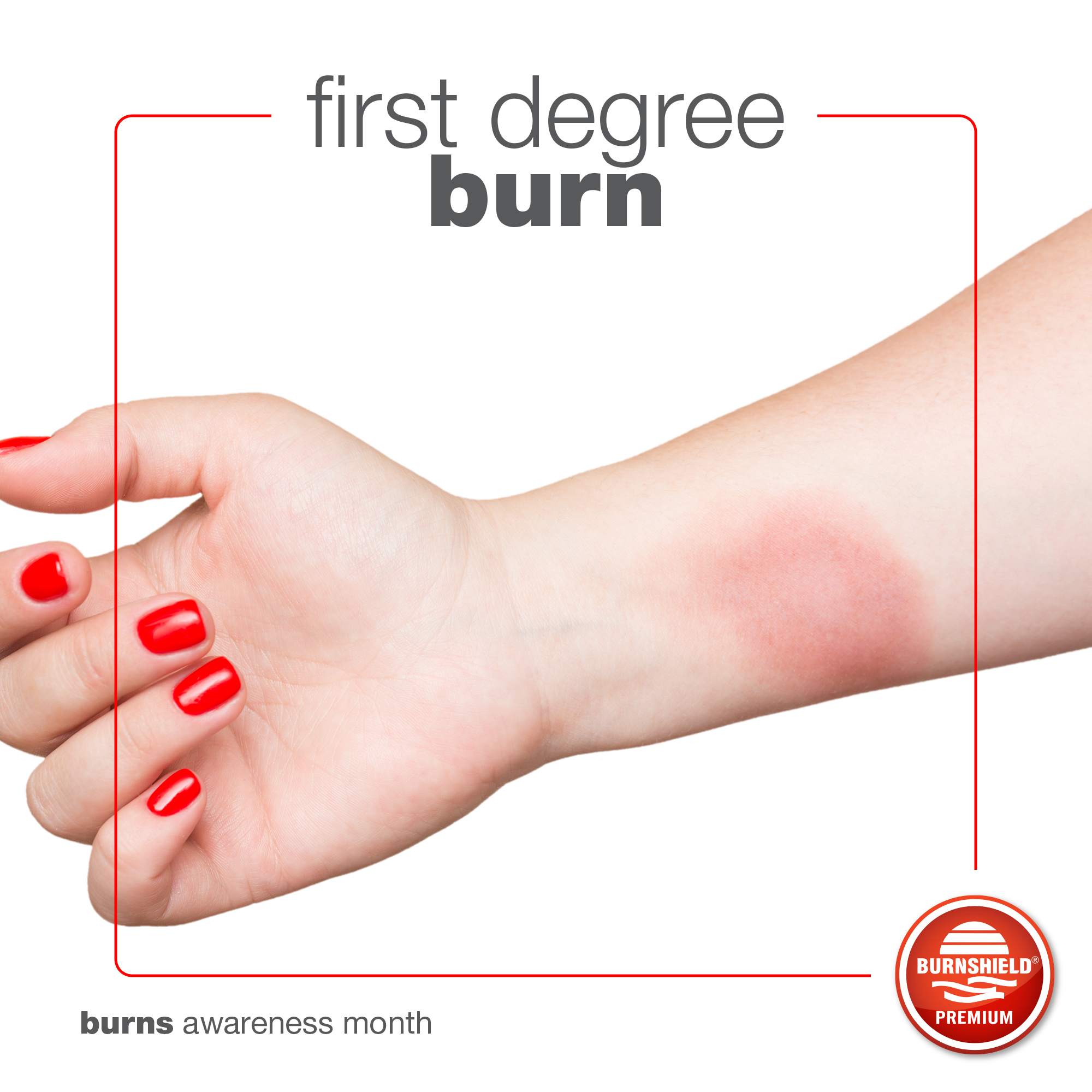 Burned Skin First Degree burned-skin-first-degree