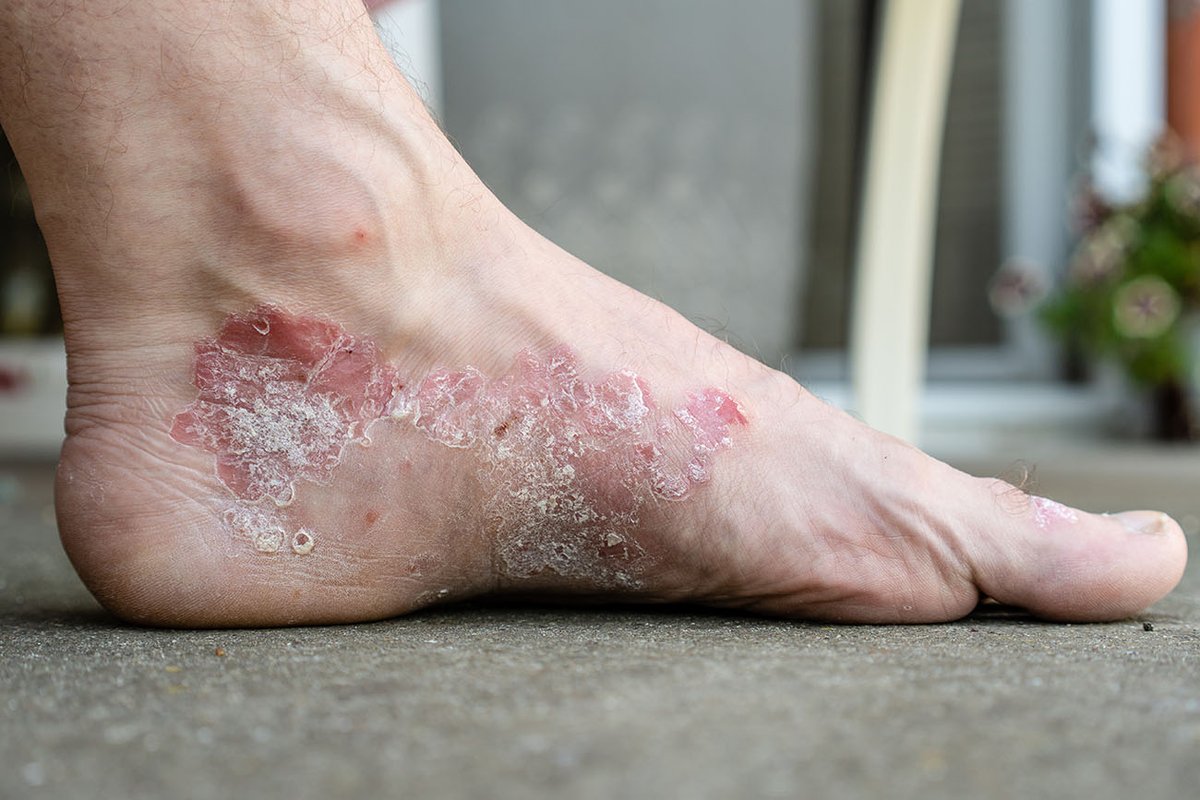 psoriasis romana)