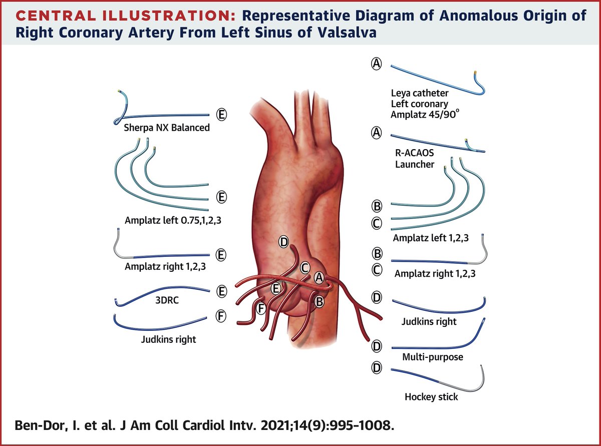 Diego Segura-Rodríguez (@seguracardio) on Twitter photo 📌Catheter Selection & Angiographic Views for Anomalous Coronary Arteries: A Practical #Guide at <a href="/JACCJournals/">JACC Journals</a> : A #StateOfTheArt for my #radialfirst colleagues📚 📌Catheter Selection & Angiographic Views for Anomalous Coronary Arteries: A Practical #Guide at <a href="/JACCJournals/">JACC Journals</a> : A #StateOfTheArt for my #radialfirst colleagues📚
