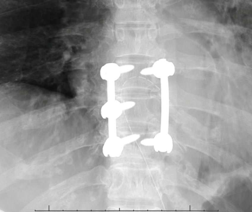 JackJalloMD's tweet photo. 50yo female w/worsening ambulatory dysfunction, otherwise healthy. Found to have a thoracic intradural extramedullary #TUMOR #Spine #MedTwitter @TJUHNeurosurg @NeuroatJeff @TJUHospital https://t.co/fcVGTaUJMg