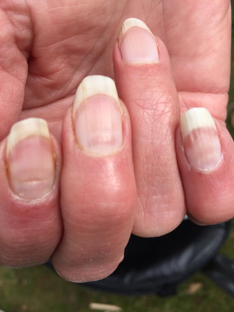 Tim Spector MD (Prof) on Twitter: "Do your nails look odd? COVID nails are increasingly being recognised as the nails recover after infection and the growth recovers leaving a clear line. Can