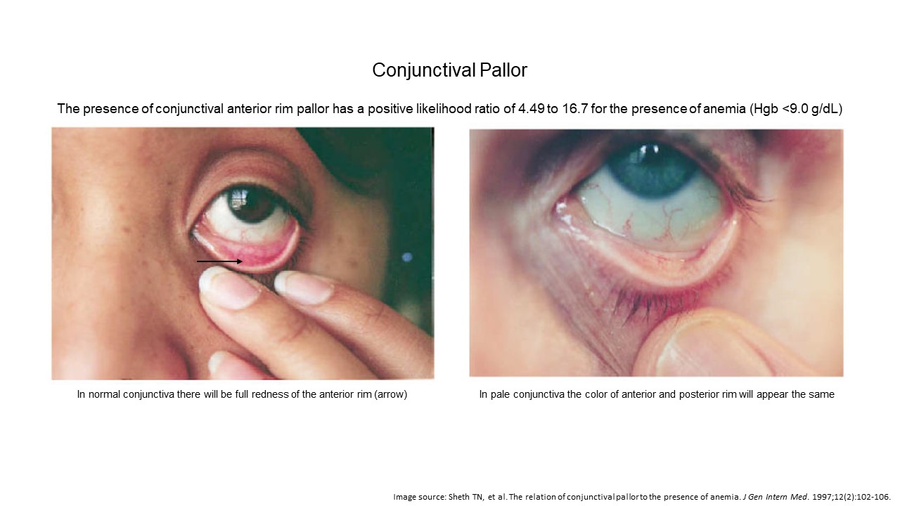 Anemia Eyes Vs Normal Eyes