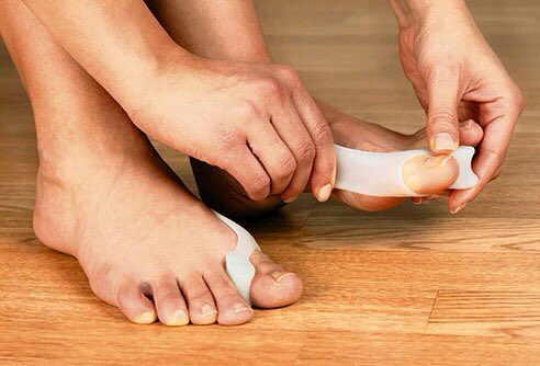 Bunions https://t.co/bmKFEmDbQP