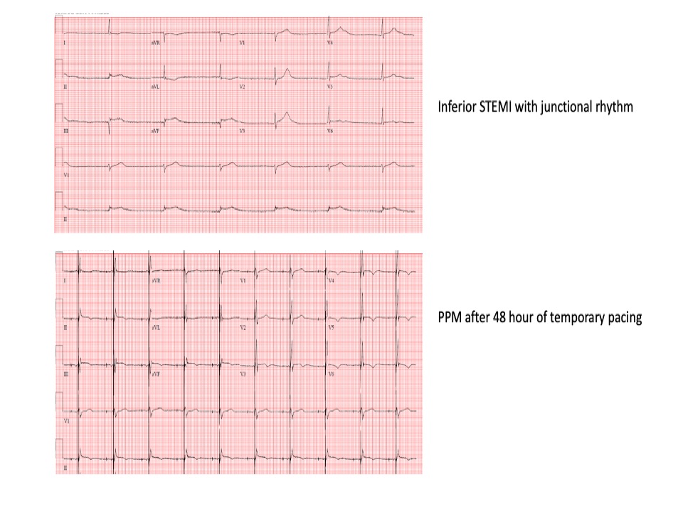 Should this be called bi-bundle pacing? PPM implant 48 hrs post inferior STEMI. Not LBBA pacing (no RBBB). Not his pacing (no HV/pacing delay or fusion, no his recorded on the lead). QRS morphology nearly identical compared to presenting ECG with evolving ST-T changes
