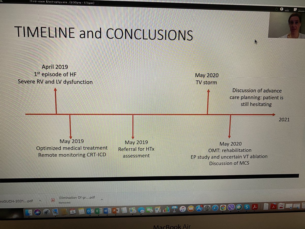 Alexandra Frogoudaki (@alexfrogoudaki) on Twitter photo Heart failure and arrhythmias hand by hand in this ccTGA very young pt. Third wave @EuroGUCH21, excellent presentation by <a href="/Mag_Ladouceur/">Magalie Ladouceur</a>. <a href="/ralogon/">Rafa Alonso</a> @swan_lorna <a href="/apgalgar/">Pastora Gallego</a> <a href="/LauraDos8/">Laura Dos</a> <a href="/WernerBudts/">werner budts</a> @gerharddiller Heart failure and arrhythmias hand by hand in this ccTGA very young pt. Third wave @EuroGUCH21, excellent presentation by <a href="/Mag_Ladouceur/">Magalie Ladouceur</a>. <a href="/ralogon/">Rafa Alonso</a> @swan_lorna <a href="/apgalgar/">Pastora Gallego</a> <a href="/LauraDos8/">Laura Dos</a> <a href="/WernerBudts/">werner budts</a> @gerharddiller