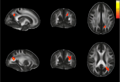cerebro_rs's tweet photo. Estamos muito orgulhosos! Foi publicado na prestigiada revista internacional Translational Psychiatry, que faz parte do grupo Nature, um artigo do InsCer conduzido por @grassirod e desenvolvido por Lucca Tondo sobre os danos causados pelo crack-cocaína! https://t.co/mzY5mROKOS https://t.co/9x6rnhN6LI