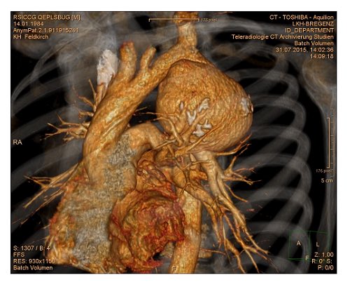 cardiopedhnn's tweet image. Examples of: 

1-2. Congenital aneurysm of ductus_arteriosus 
doi.org/10.1016/j.jped…

3. Pseudo aneurysm of proximal Desc. Thoracic Ao after Coarctation Ao repair 
mmcts.org/tutorial/1148

4. Rupture of Ao Arch aneurysm 
doi.org/10.1016/j.jvs.…

#aortic_aneurysms #whyCCT