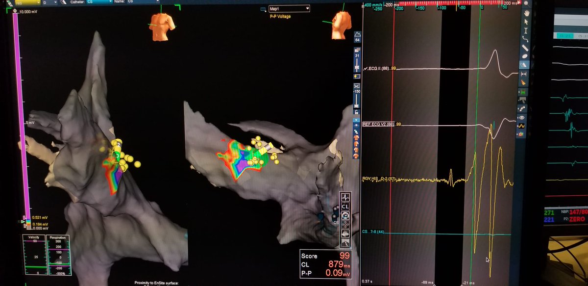 J_Colley_MD's tweet photo. Excellent result with the new #Abbott #agilis #hispro His bundle deflectable sheath. 3D mapped His bundle to deploy #pacemaker lead. Note good quality His bundle signal on sheath to assist localizing pacing target. @JoeLightsey @Myles_Honicker #EPeeps @JacksonHeartMS https://t.co/KcMlQqdYsj