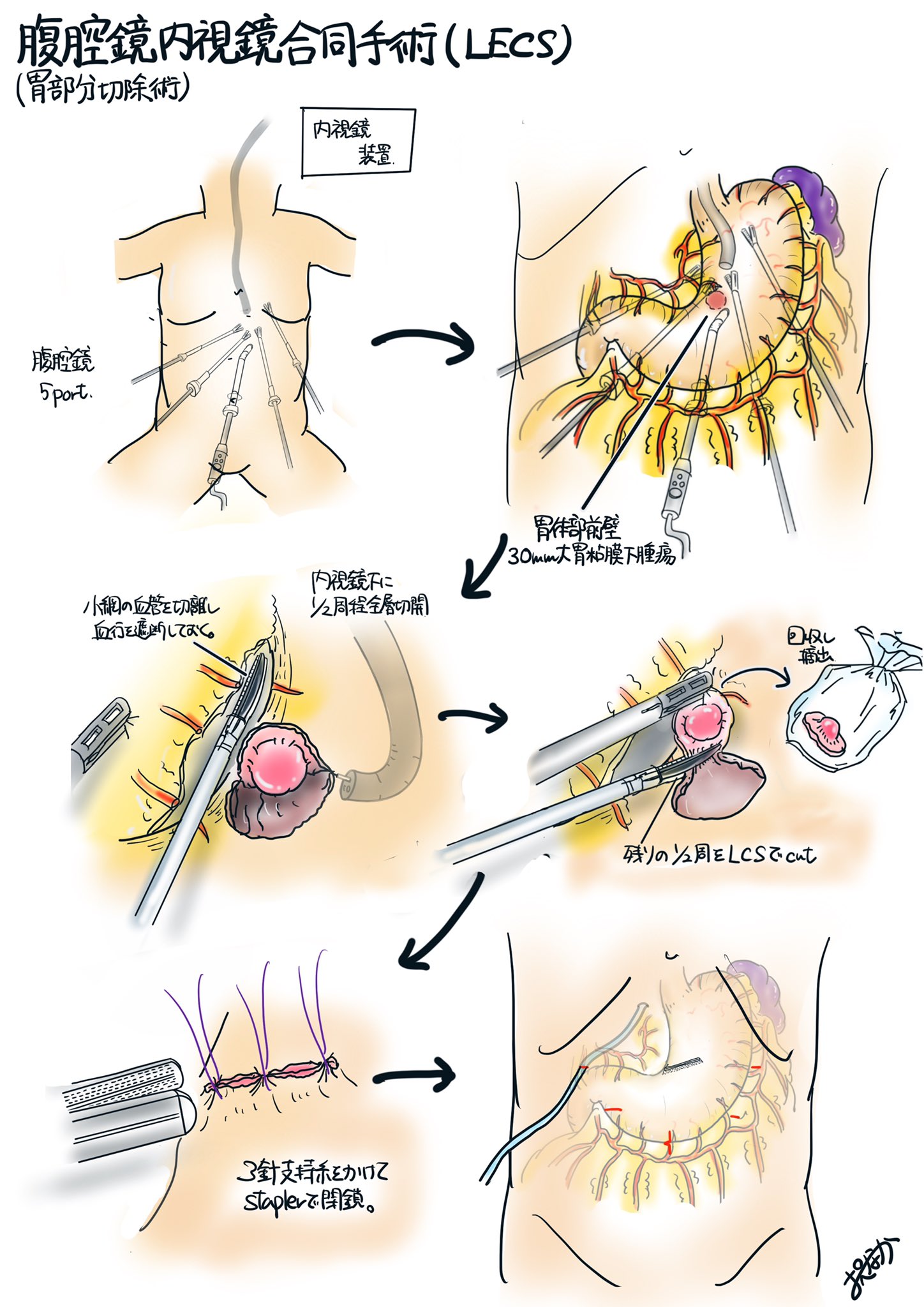LECS?イラストと写真で見る内視鏡医と外科医のコラボレーション手術 腹腔鏡 内視鏡合同手術研究会 Amazon.co.jp: LECS イラストと写真で見る内視鏡医と外科医