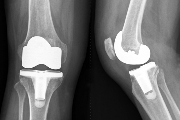 ASC's continue to adopt robotic technology for total joint replacements. Don Hohman, MD joins #TheCuttingEdgePodcast this week to discuss how robotics has improved outcomes for his patients receiving knee replacements.  #Healthcare #TotalJoints #OrthopedicSurgery #THCDS