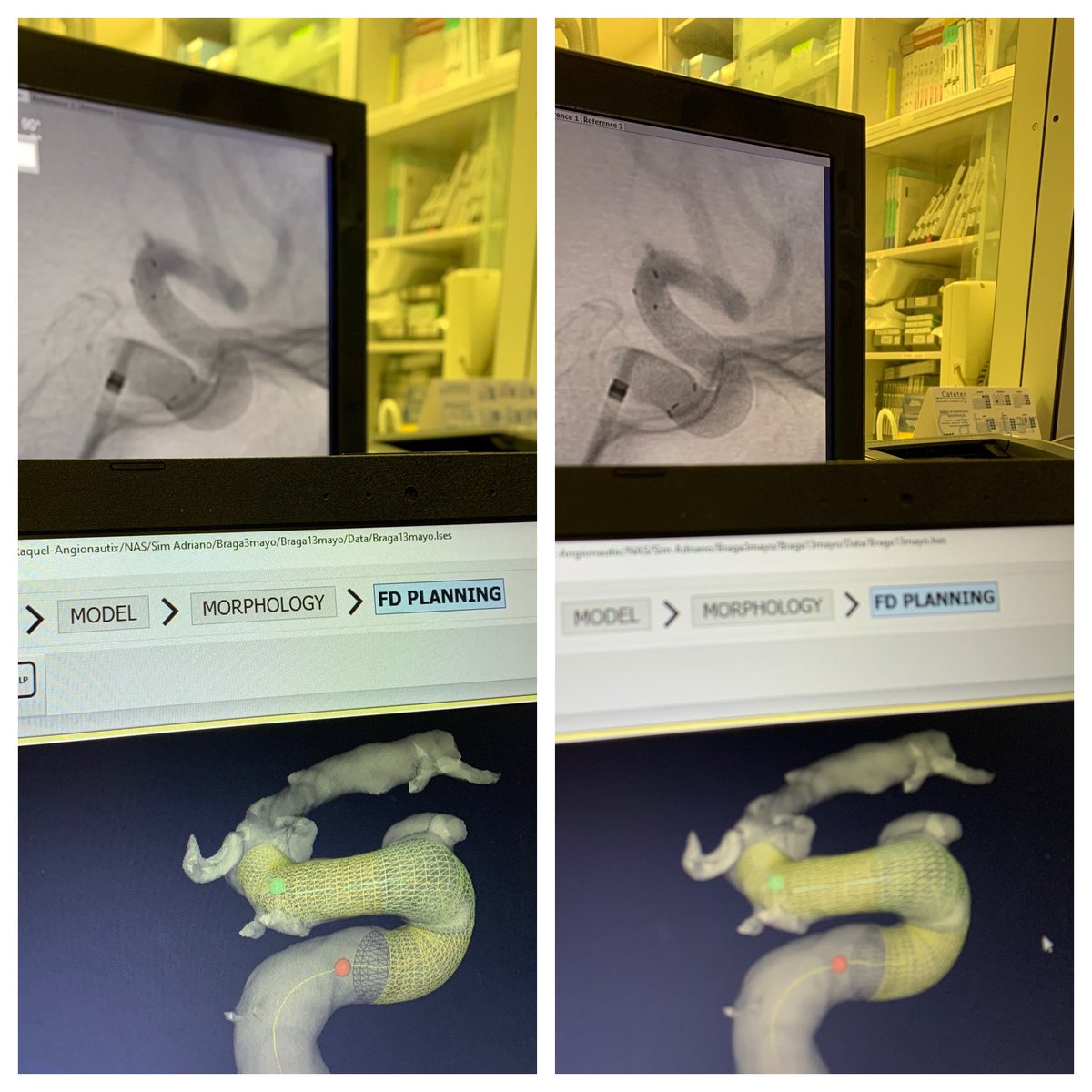 JosAmor72456684's tweet image. First time using Derivo FD. The deployment felt somewhat different from the other FDs but we got it pretty much were we wanted it // Benchmark 6F - Phenom Plus - Neuroslider 0.027 #radialfirst #pipeit