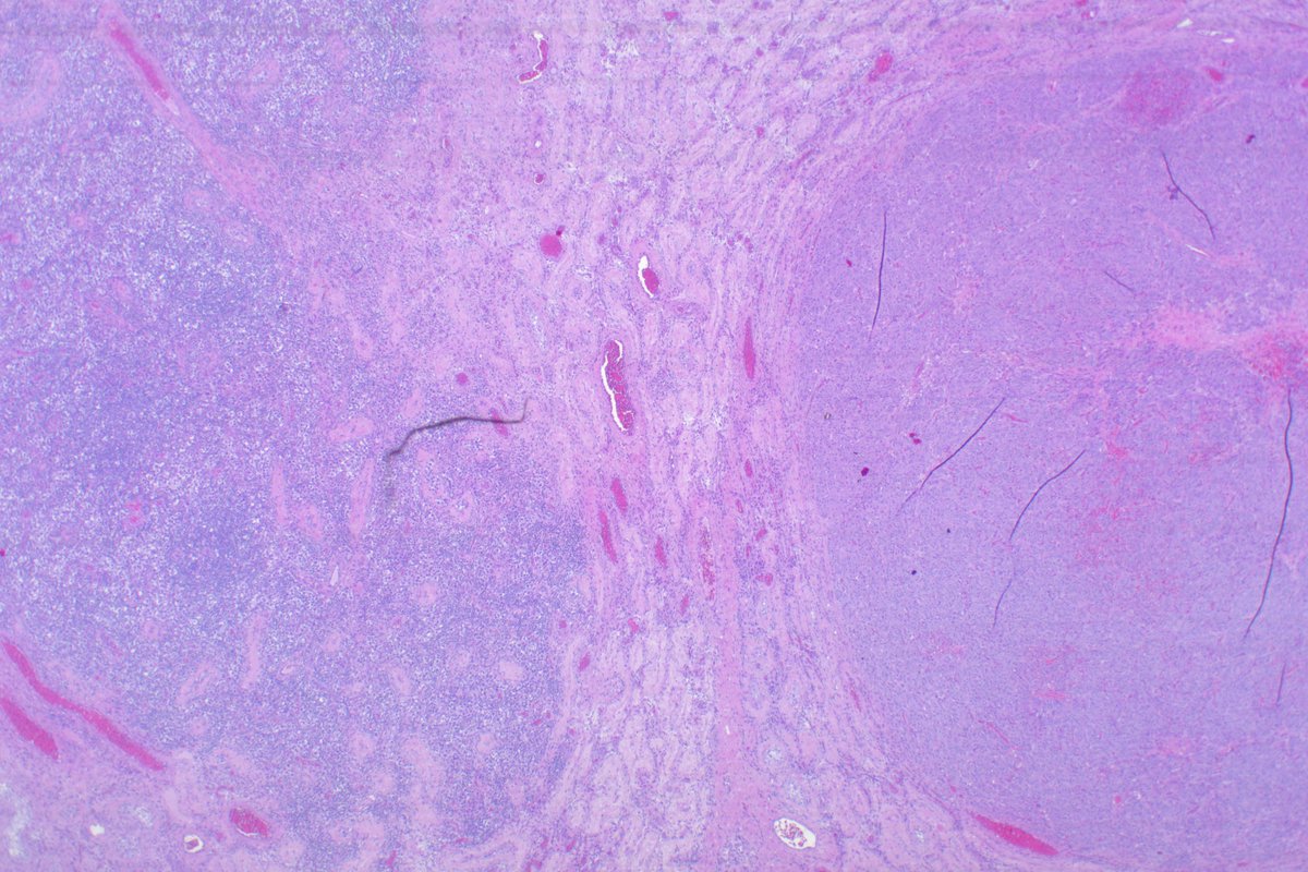 germcell and sex cord tumor in the same testis (inhibin stain) lovely case