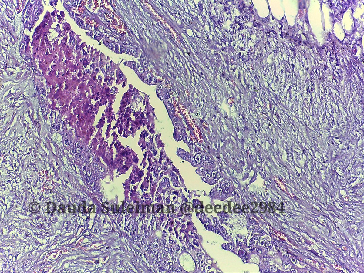 Feline Pancreatic Ductal Carcinoma #Pathology #VetPath 
Sometimes we have to deal with biopsies from other species. See the striking desmoplasia.

The cat was 11 years old😥
@DrGeeONE @nusrat_xahra @drlawalm @ariella8 @redsnapperpath @JMGardnerMD @LizMontgomeryMD