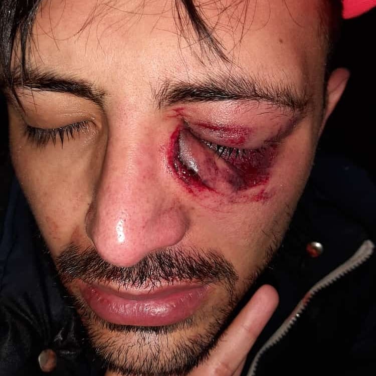 MichaelMarin_M's tweet photo. Bogotá colombia, barrio Candelaria la nueva nos disparan a quema ropa y apuntando a la cabeza. Aquí el resultado !!
#SOSColombiaDDHH #NosEstanMasacrando #FuerzaCOLOMBIA #AsesinosCobardesDelEsmad #BogotaEnAlertaRoja #ColombiaEnAlertaRoja https://t.co/D31k7k58Cc