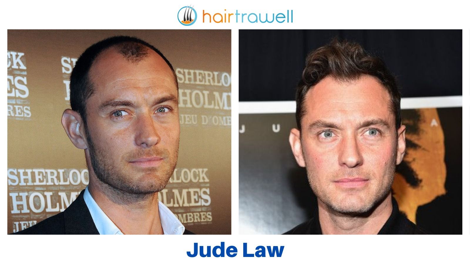 HairTrawell auf Twitter: „Jude Law, one of the most venerated actors of his  generation, had a hair transplant! #judelaw #judelawhair #celebrityhair  #celebritybeforeafter #beforeafterhair #hairtransplantinistanbul  #hairtransplantationturkey ...