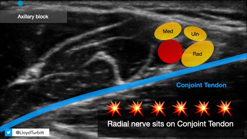 Tip for axillary block: Identify the conjoint tendon. Radial nerve always lies on the conjoint tendon. #RAUK21 #TurbittsTopTips