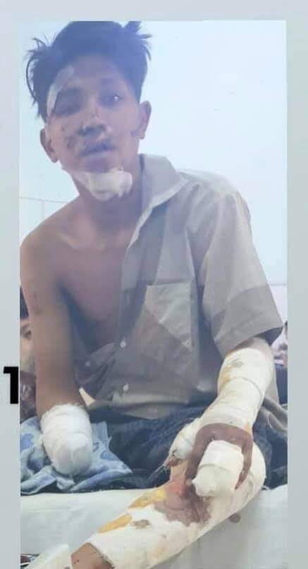 daffodilpht98's tweet photo. @freya_cole HlyanPhyoAung was abdudcted on 27th March.Multiple shots on legs and hands. Now his right hand's imputated, left hand broken n one eye was lost yet no surgery. He's been charged by many panel codes. 
#CrimesAgainstHumanity 
#WhatsHappeningInMyanmar https://t.co/cOzDugqzJh