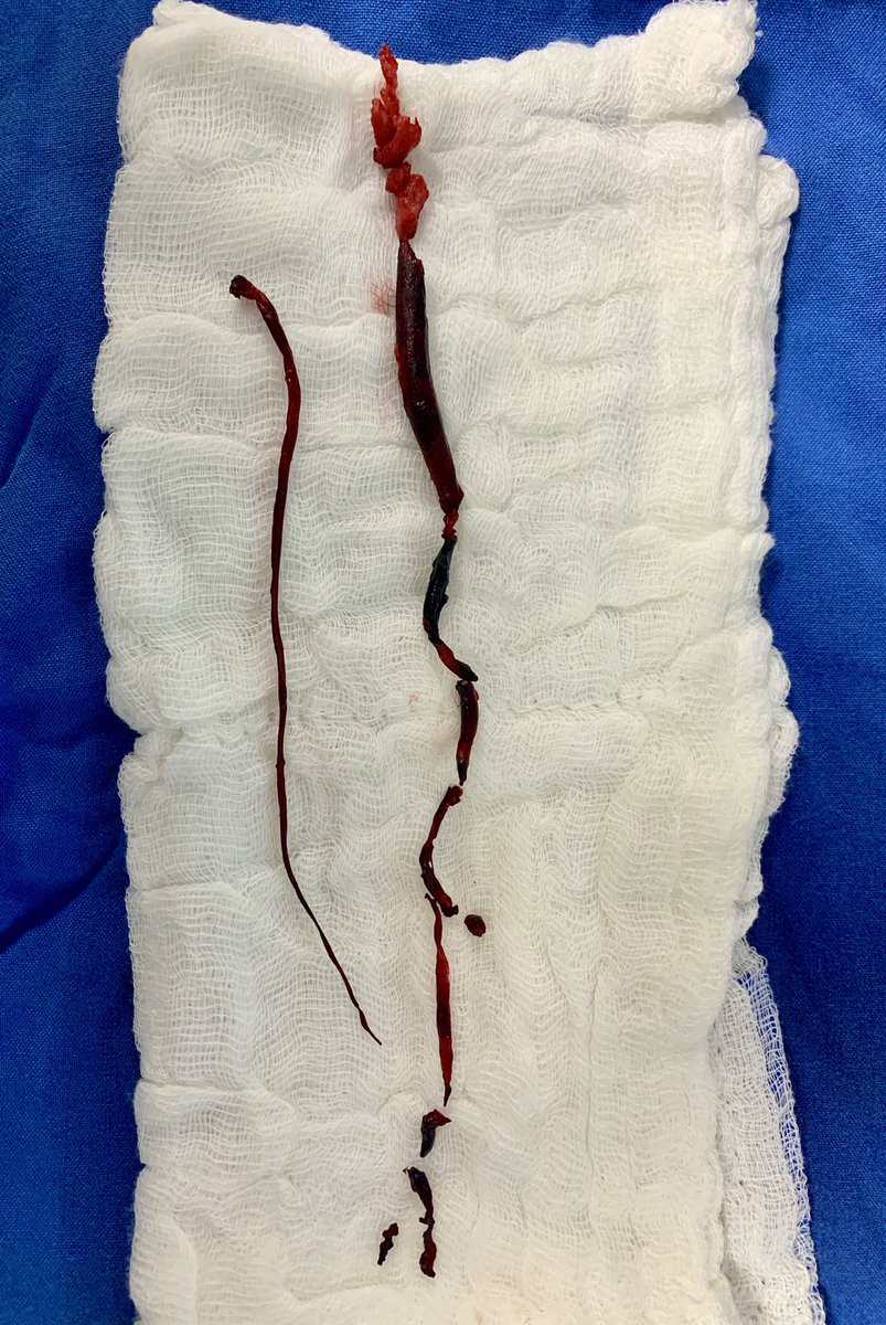 What Covid clots look like. Covid produces blood clots. The incidence of heart attack, stroke, or limb loss due to an arterial clot in Covid varies from 2%-5%. We pried these out of the lower limb arteries of a Covid patient. We were able to save the limb.