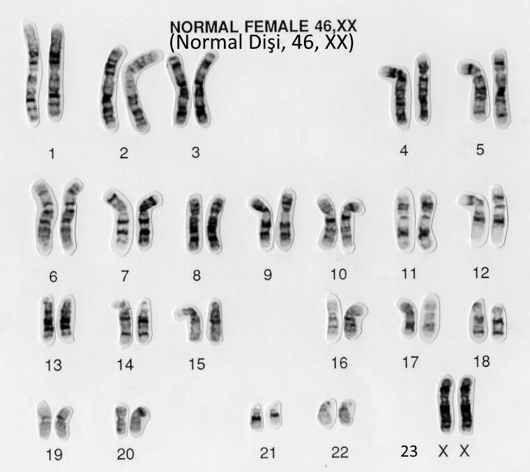 46 хромосом 1. Нормальный кариотип женщины 46 ХХ. Кариотип 46 XX У женщин что это. Кариограмма хромосом мужчины. Кариотип 46 ХХ.