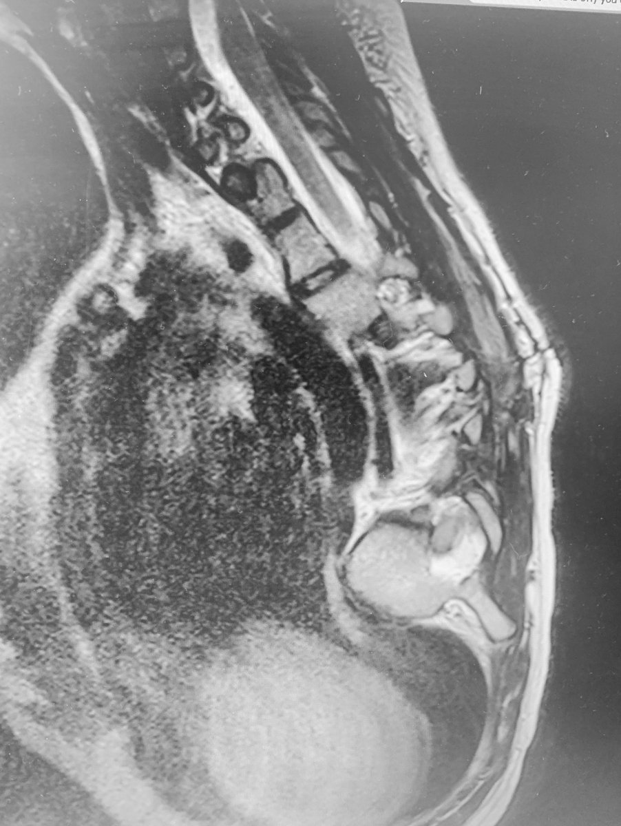 Introducing the “90  degree sign”. When you see axial cut of the vertebra or disc in a sagittal recon the Cobb angle of the curve is 90 degrees or more