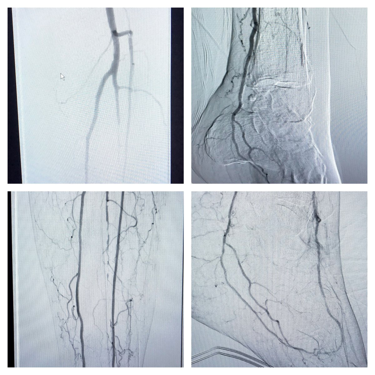Sasha Ushinsky (@sushinsk) on Twitter photo Anterior Tibial and Plantar Arch revascularization for CLTI. Not pictured (Shockwave Lithoplasty and stenting SFA and Popliteal). All in a day's work <a href="/WashUIR/">Mallinckrodt IR</a> <a href="/CarlosGuevaraIR/">Carlos Guevara MD, FSIR</a> <a href="/arian_nasiri/">Arian Nasiri</a> <a href="/RCobbMD_IR/">Ryan Cobb MD</a> <a href="/K_Langy/">Kris L</a> Anterior Tibial and Plantar Arch revascularization for CLTI. Not pictured (Shockwave Lithoplasty and stenting SFA and Popliteal). All in a day's work <a href="/WashUIR/">Mallinckrodt IR</a> <a href="/CarlosGuevaraIR/">Carlos Guevara MD, FSIR</a> <a href="/arian_nasiri/">Arian Nasiri</a> <a href="/RCobbMD_IR/">Ryan Cobb MD</a> <a href="/K_Langy/">Kris L</a>