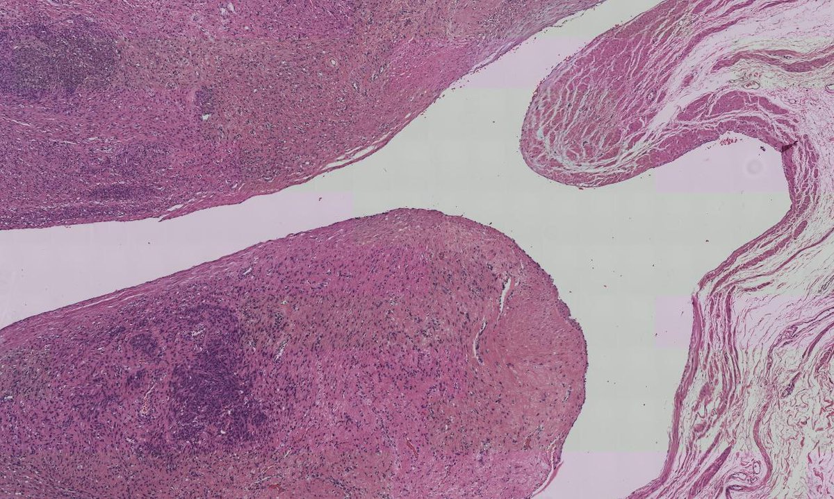 invasive squamous cell carcinomas