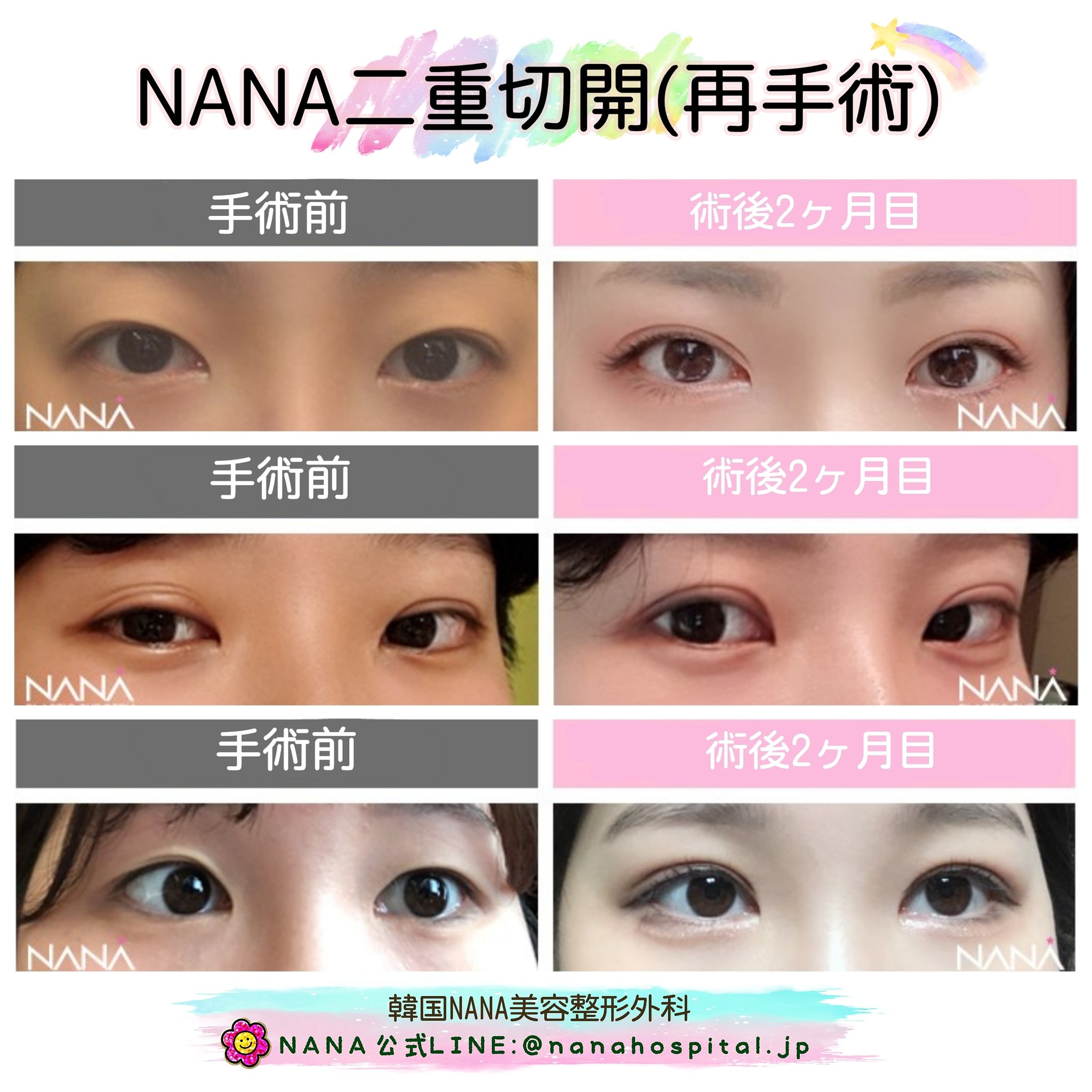 韓国整形nana美容外科 韓国整形 Nana美容外科 二重切開 再手術 ビフォーアフター 他にも 目 整形 をご検討中の方々は お気軽くお問い合わせ下さい T Co Uktu5b4nbb 二重全切開 二重整形 美容整形 韓国在住 韓国留学 日韓夫婦