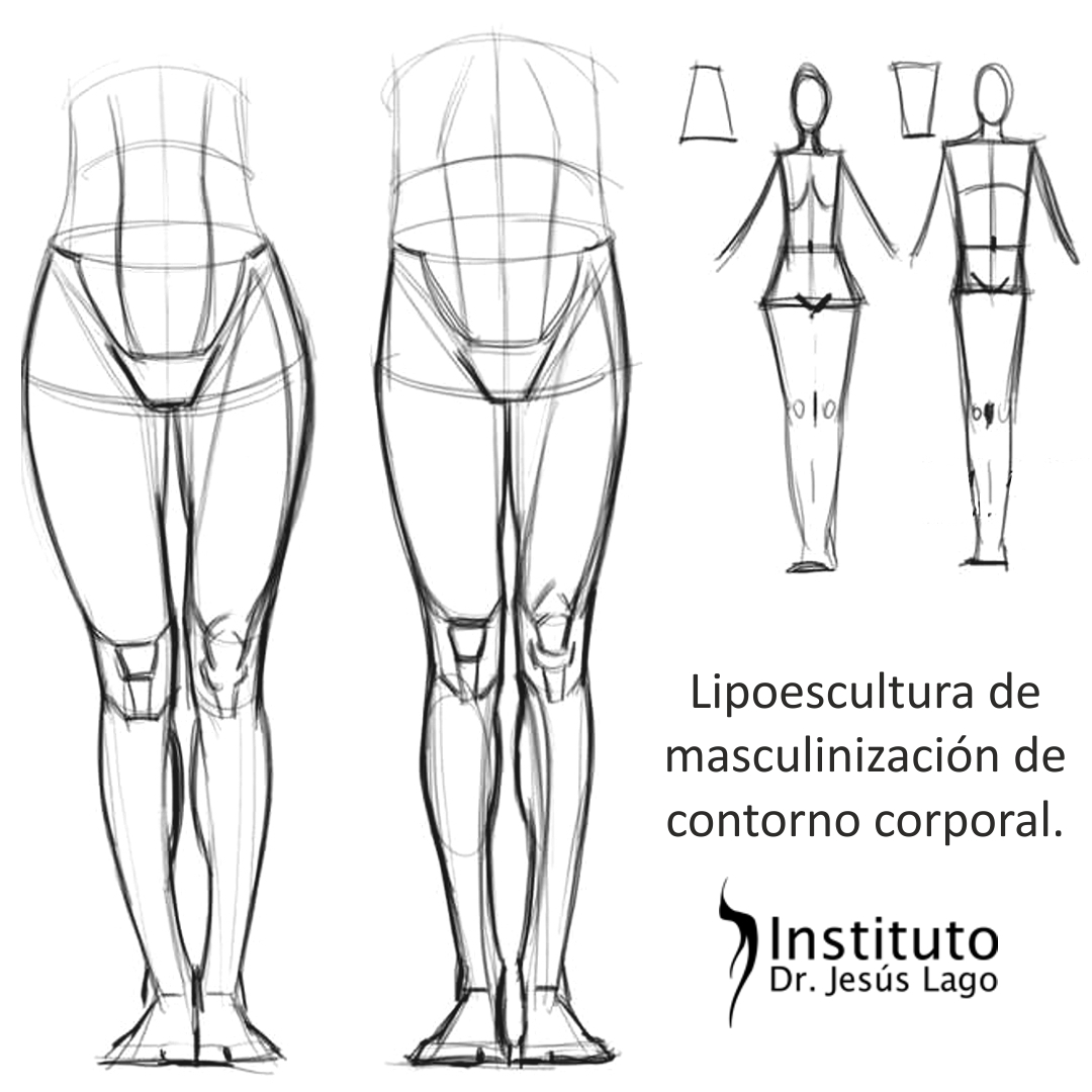 Lipoescultura de masculinización corporal. La distribución de grasa  corporal entre hombres y mujeres tiene claras diferencias, el hombre tiene  un tórax más cónico y una cadera más recta, por este motivo cuando, image size:1080x1080