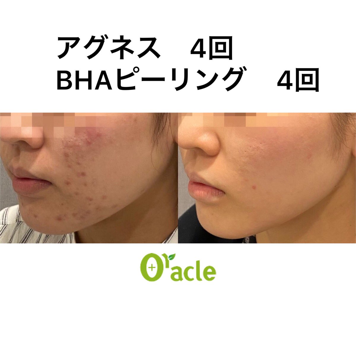 オラクル美容皮膚科【公式】 on X